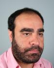 Before Hair Transplant&nbsp;2 Sessions (Areas)